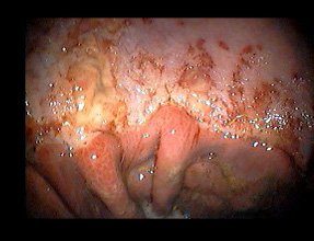 Gastric-Ulcers-back